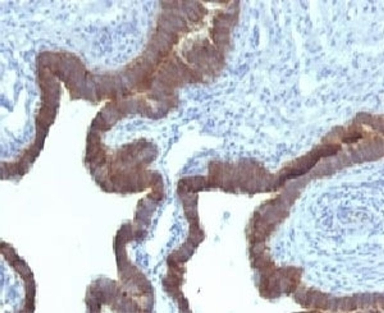 Formalin-fixed, paraffin-embedded human ovarian carcinoma stained with Cytokeratin 7 antibody (KRT7/903)