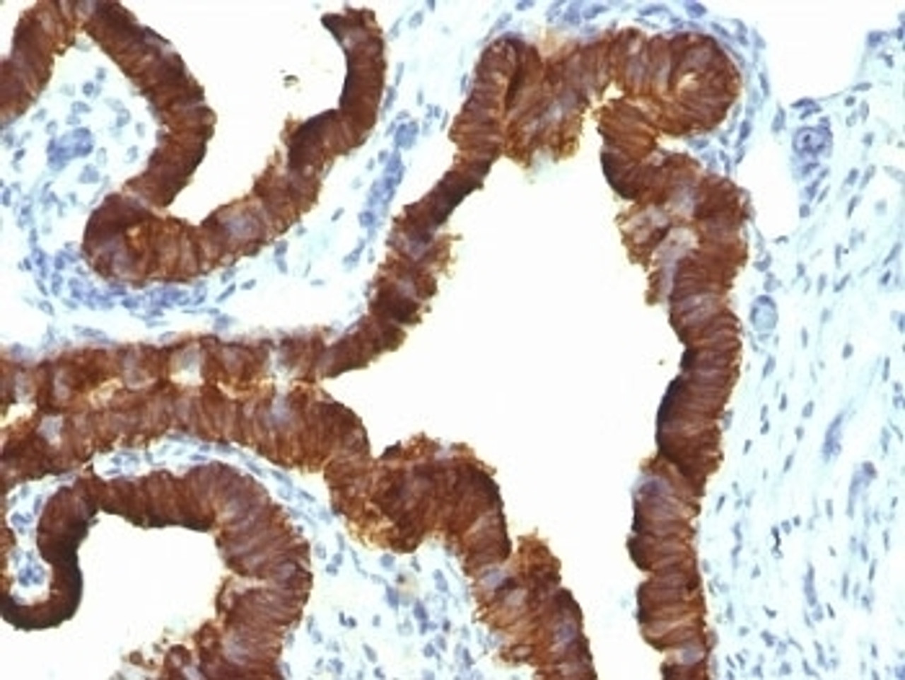Formalin-fixed, paraffin-embedded human ovarian carcinoma stained with Keratin 7 antibody (KRT7/1198)