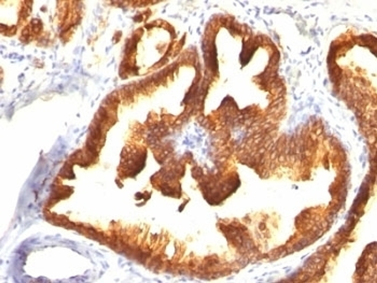 Formalin-fixed, paraffin-embedded human prostate carcinoma stained with CK18 antibody (KRT18/836) .