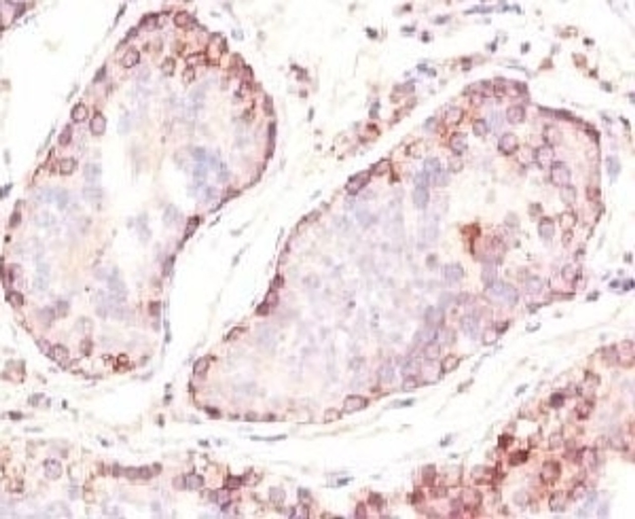 Formalin-fixed, paraffin-embedded human testicular carcinoma stained with MAGE-1 antibody (MZ2E/838) .