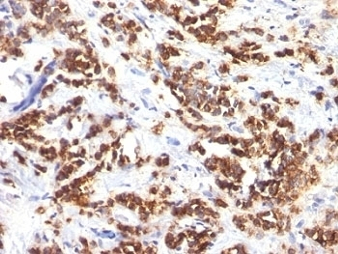 Formalin-fixed, paraffin-embedded human breast carcinoma stained with MFGE8 antibody (MFG-06)