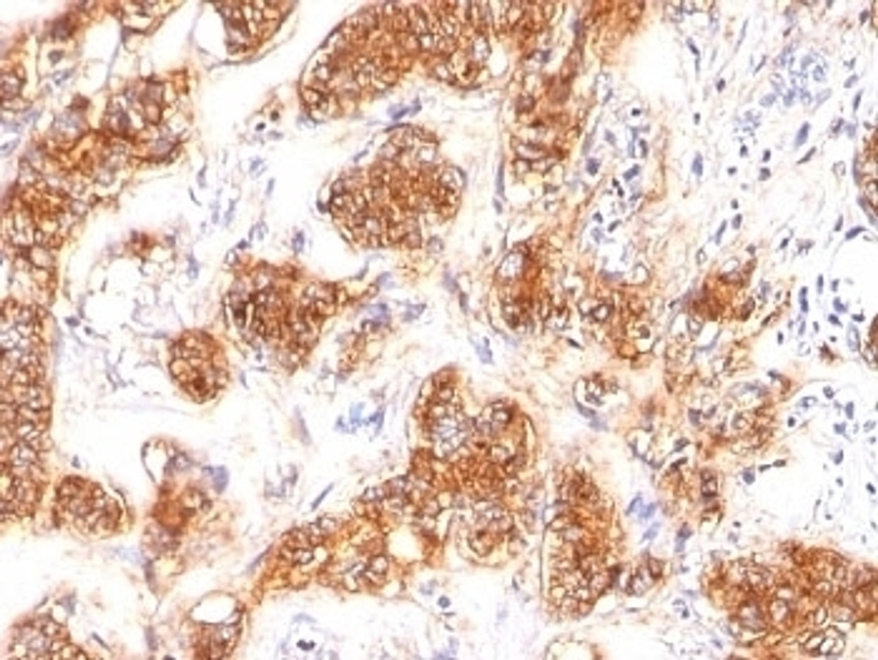 Formalin-fixed, paraffin-embedded human breast carcinoma stained with MFG-E8 antibody (SPM291)