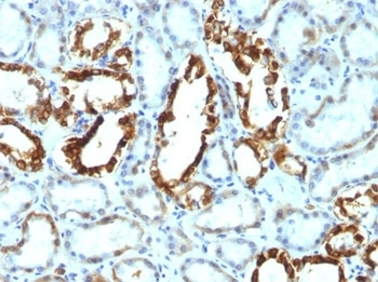 FFPE human renal cell carcinoma tested with MFG-E8 antibody (SPM291)