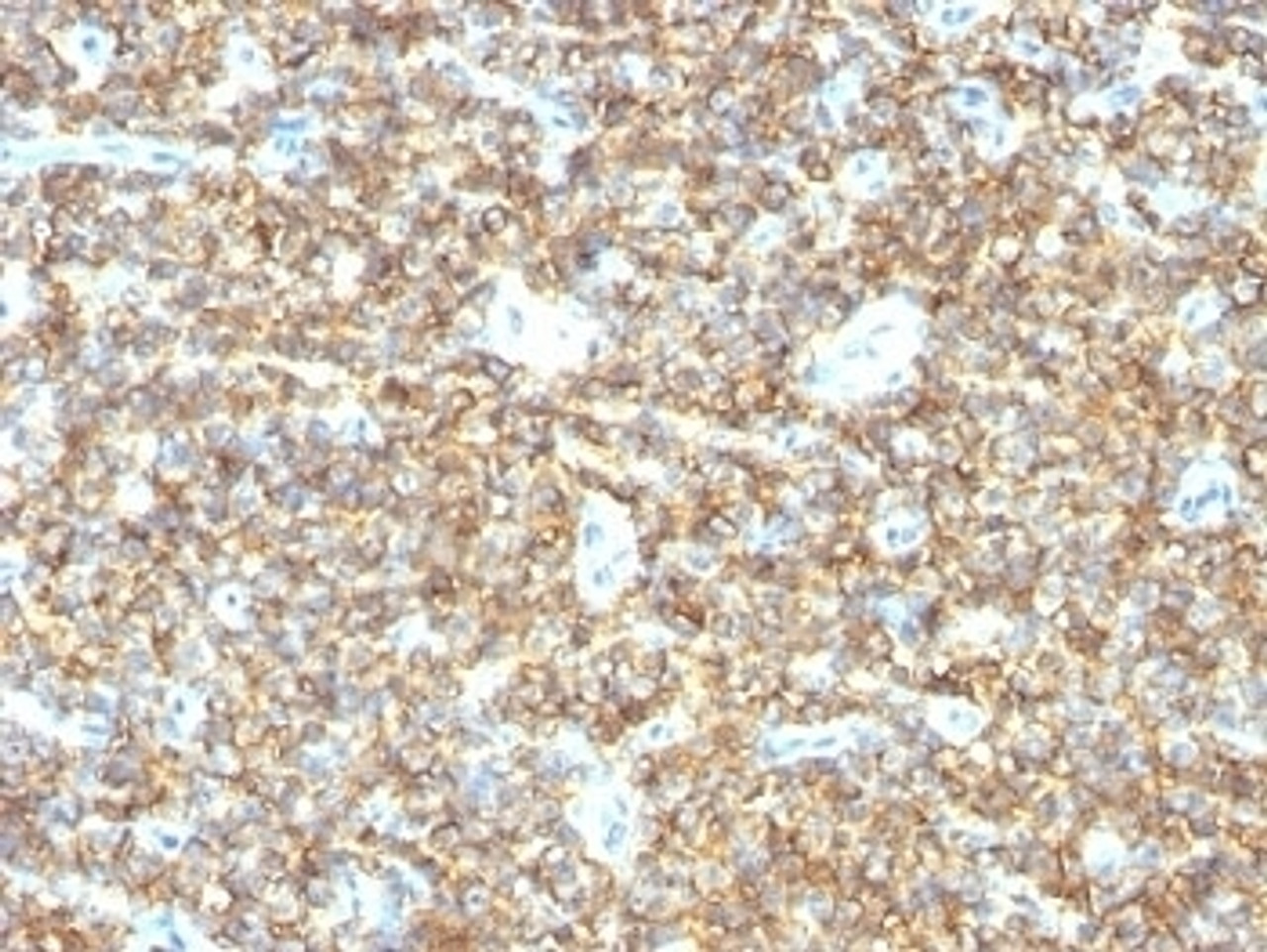 Formalin-fixed, paraffin-embedded human Ewing's sarcoma stained with CD99 antibody (HO36-1.1) .