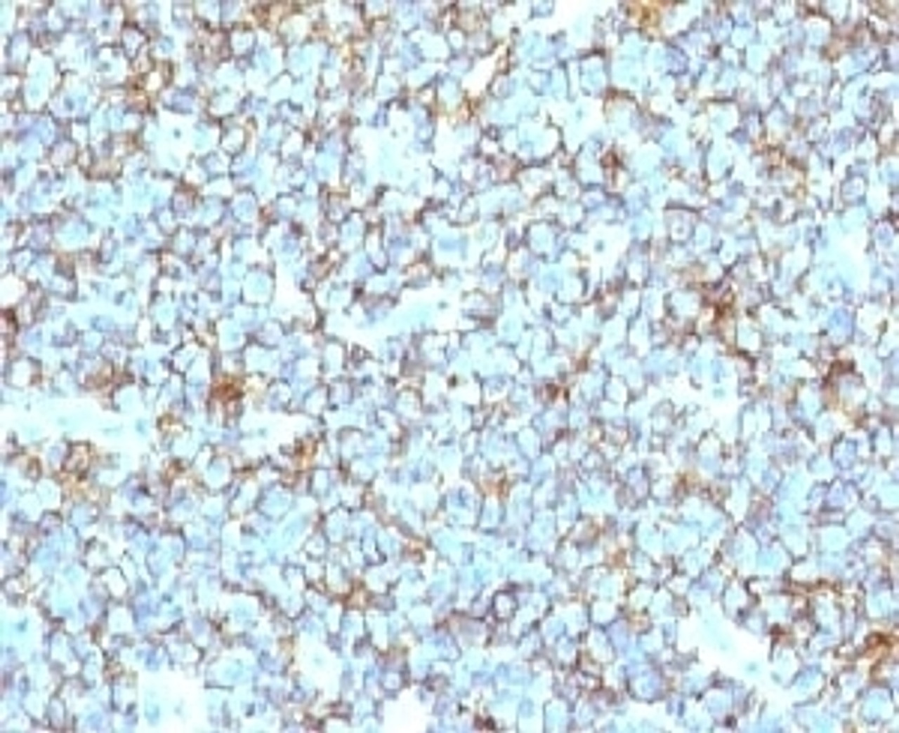 Formalin-fixed, paraffin-embedded human Ewing's sarcoma stained with CD99 antibody (MIC2/877) .