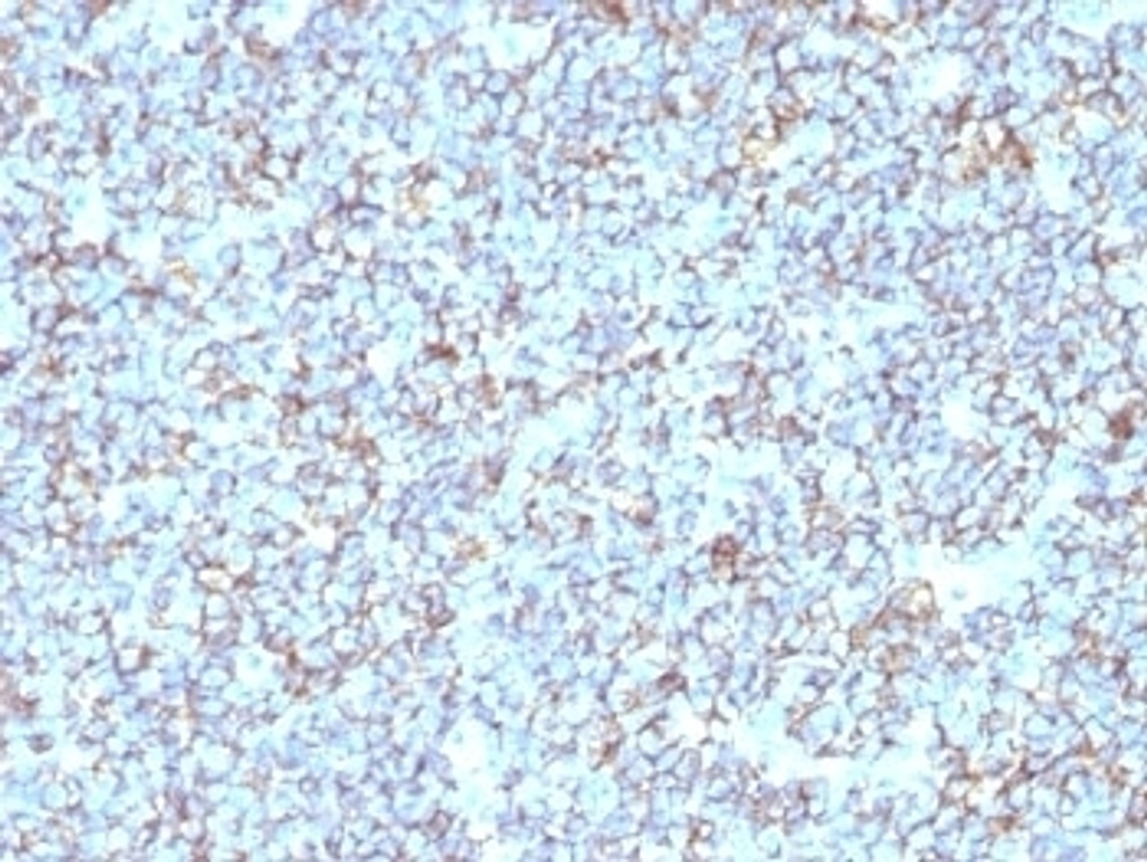 Formalin-fixed, paraffin-embedded human Ewing's sarcoma stained with anti-CD99 antibody (SPM596) .