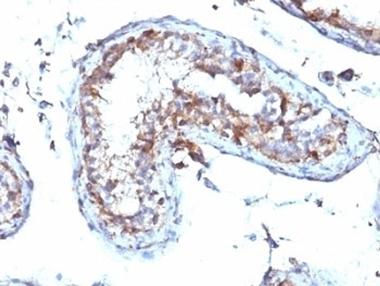 Formalin-fixed, paraffin-embedded human testicular carcinoma stained with Moesin antibody (MSN/492)