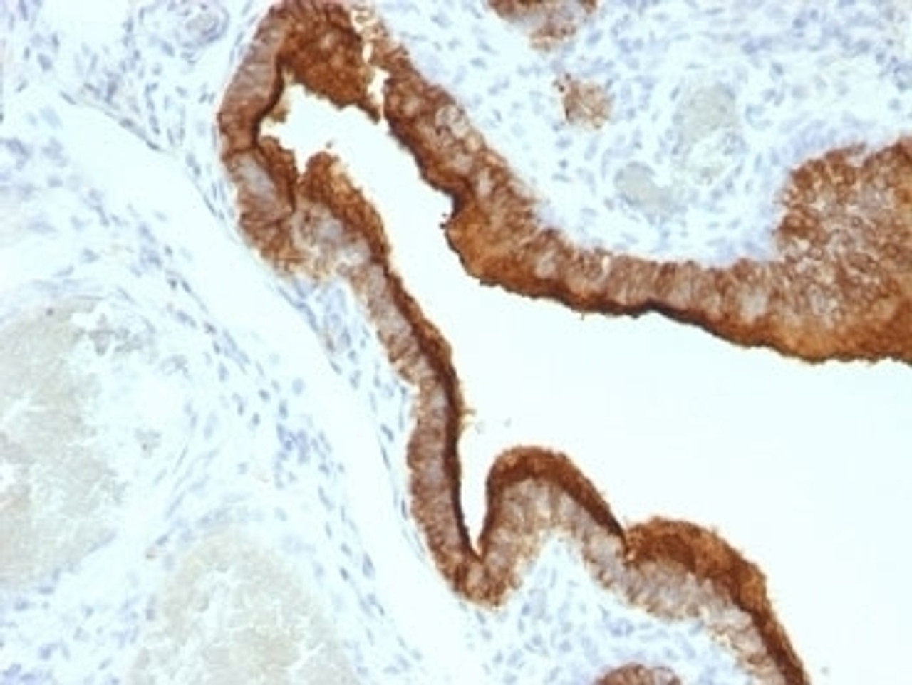 Formalin-fixed, paraffin-embedded human ovarian carcinoma stained with MUC-1 antibody (HMPV) .