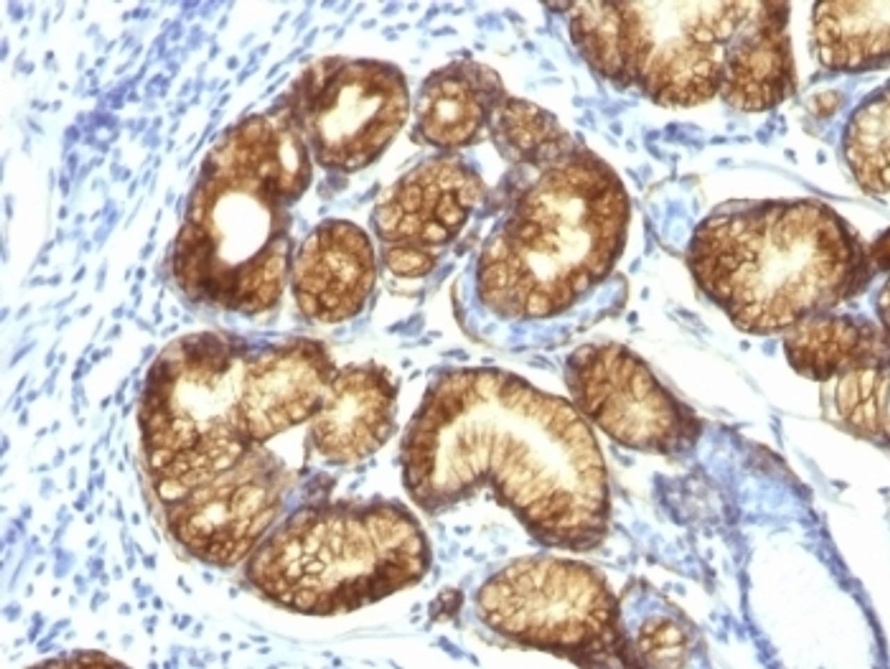 Formalin-fixed, paraffin-embedded human gastric carcinoma stained with MUC6 antibody (CLH5) .