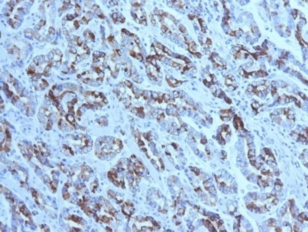 IHC testing of FFPE gastric carcinoma with MUC6 antibody (clone CLH5) . HIER: steam section in pH6 citrate buffer for 20 min and allow to cool prior to tetsting.