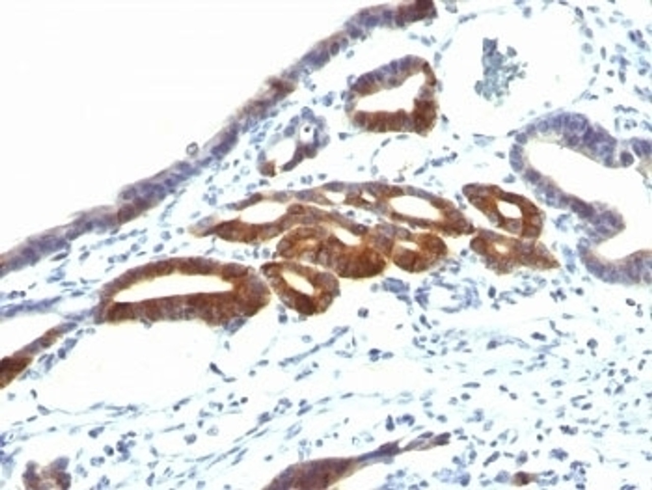 Formalin-fixed, paraffin-embedded human gastric carcinoma stained with anti-MUC6 antibody (SPM598) .
