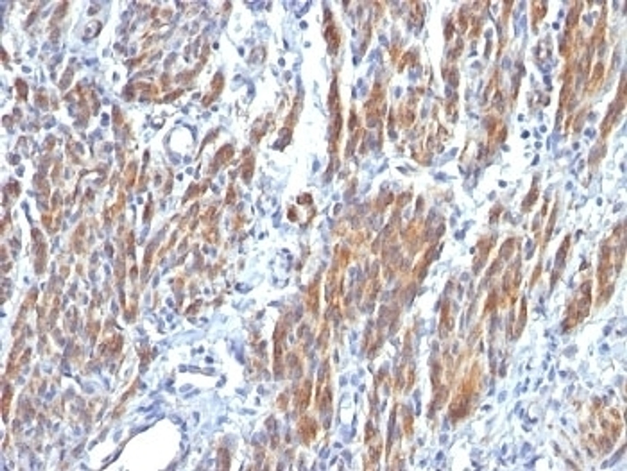 Formalin-fixed, paraffin-embedded human Leiomyosarcoma stained with SM-MHC antibody (SMMS-1) .