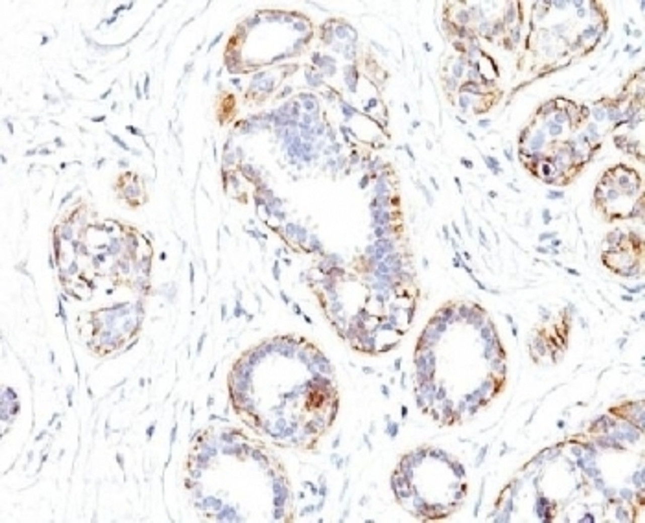 IHC testing of FFPE human breast carcinoma with SM-MHC antibody (clone SMMS-1) .