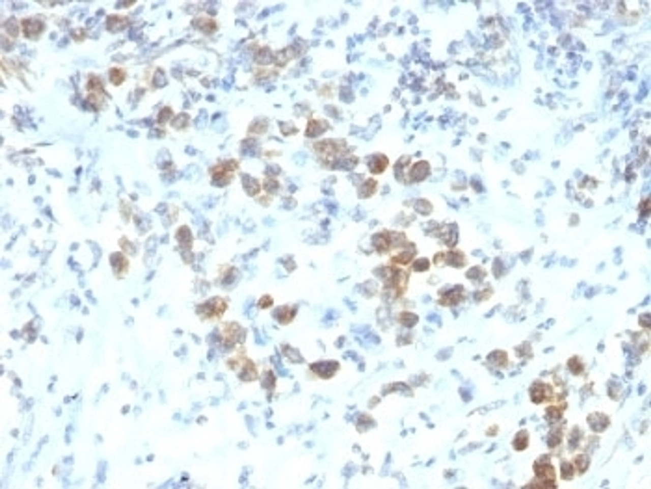 Formalin-fixed, paraffin-embedded human gastric carcinoma stained with PAX-6 antibody (SPM612) .
