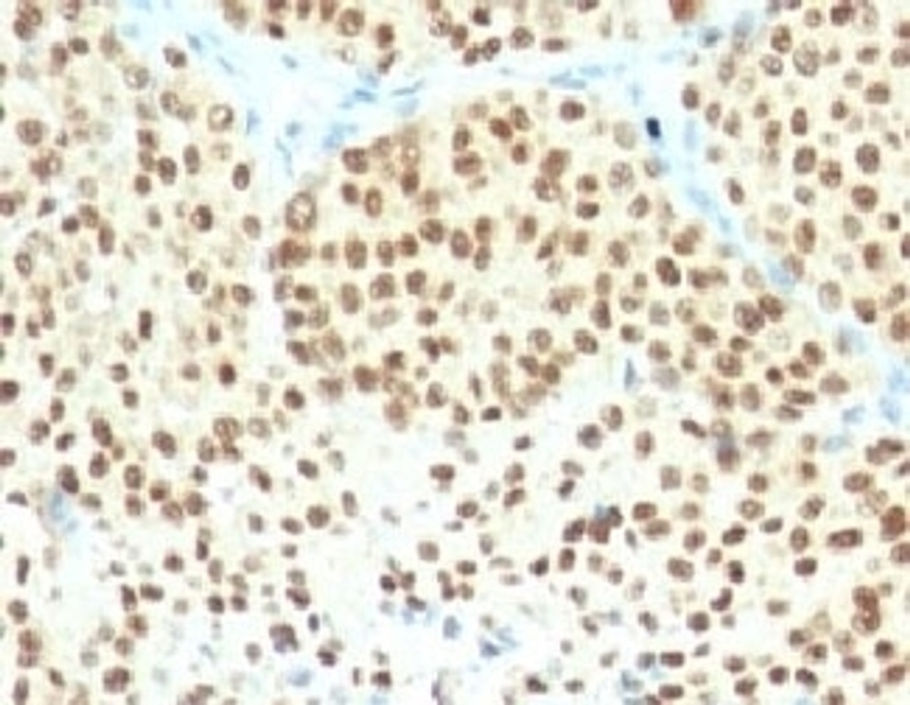 Formalin-fixed, paraffin-embedded human melanoma stained with SOX10 antibody (SPM607) .