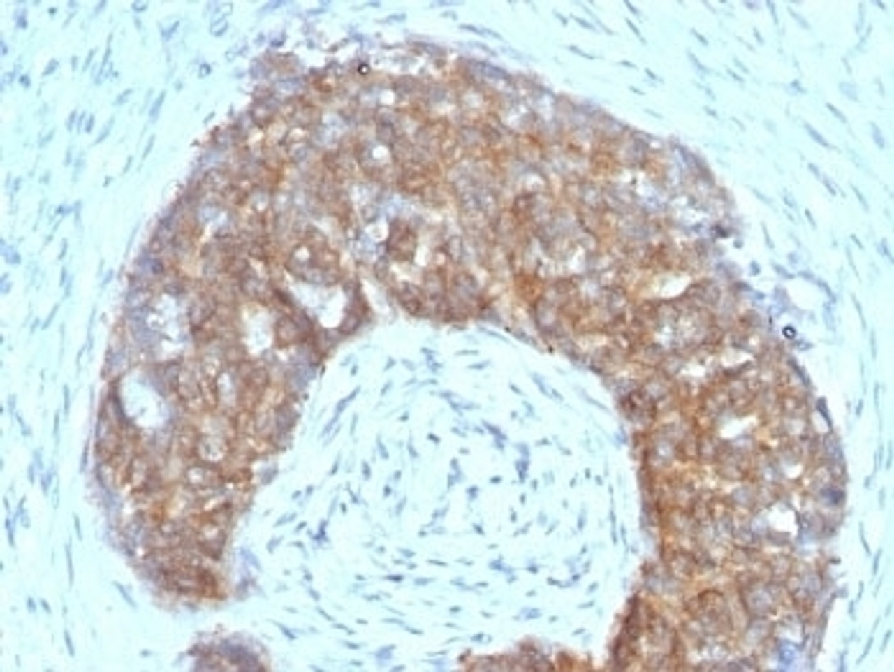 Formalin-fixed, paraffin-embedded human ovarian carcinoma stained with Estrogen Inducible Protein pS2 antibody (SPM313) .