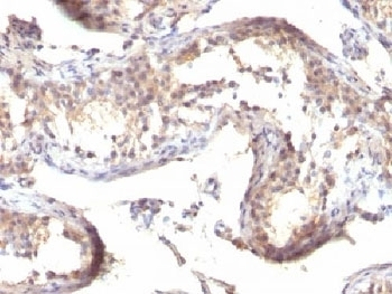 Formalin-fixed, paraffin-embedded human testicular carcinoma stained with TGFa antibody (TGFA/1119)