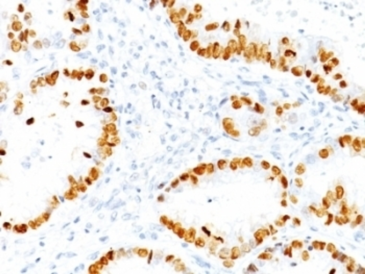 Formalin-fixed, paraffin-embedded human lung Adenocarcinoma stained with TTF1 antibody (NX2.1/690)