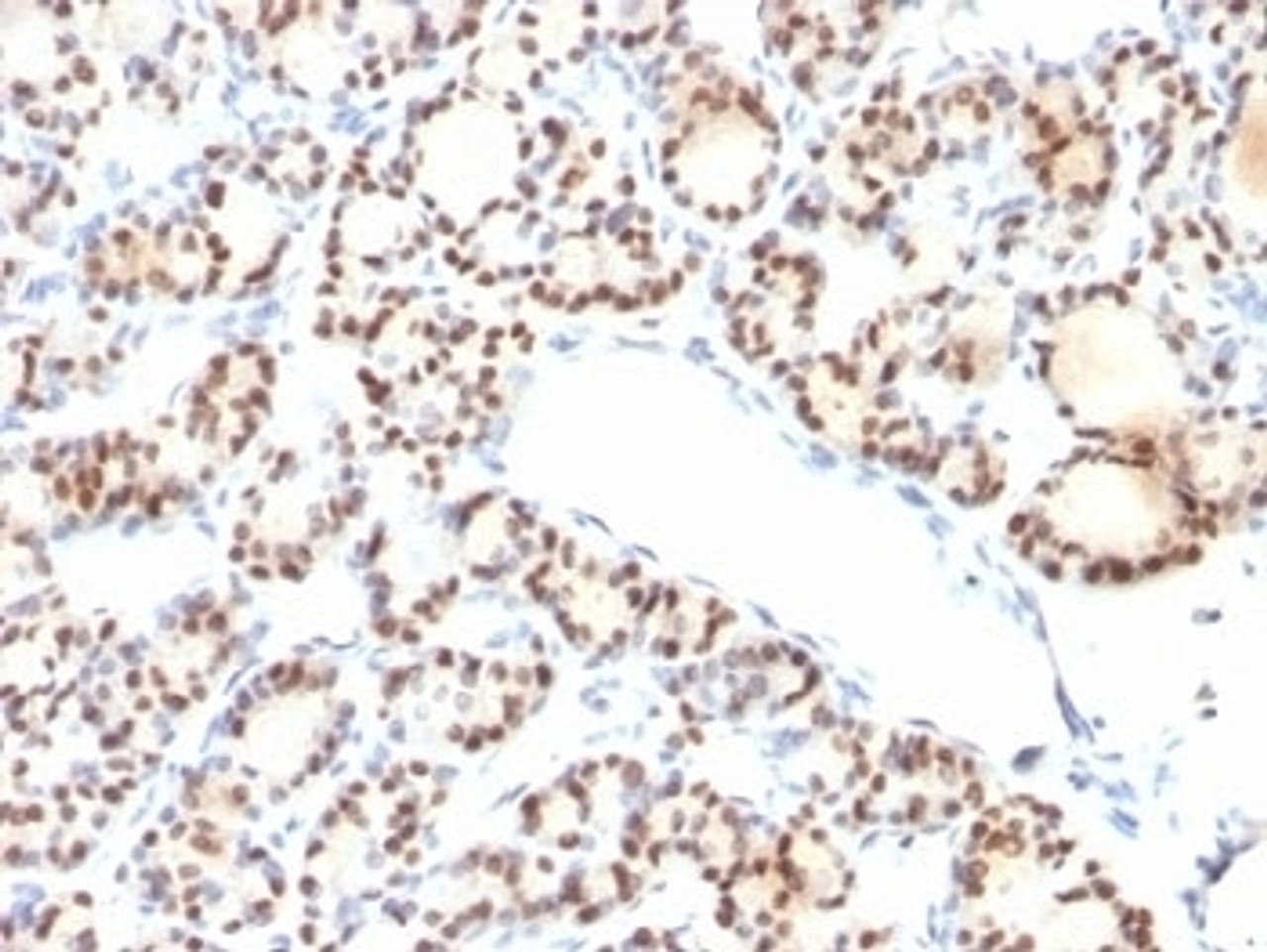 Formalin-fixed, paraffin-embedded human thyroid stained with TTF1 antibody (NX2.1/690)