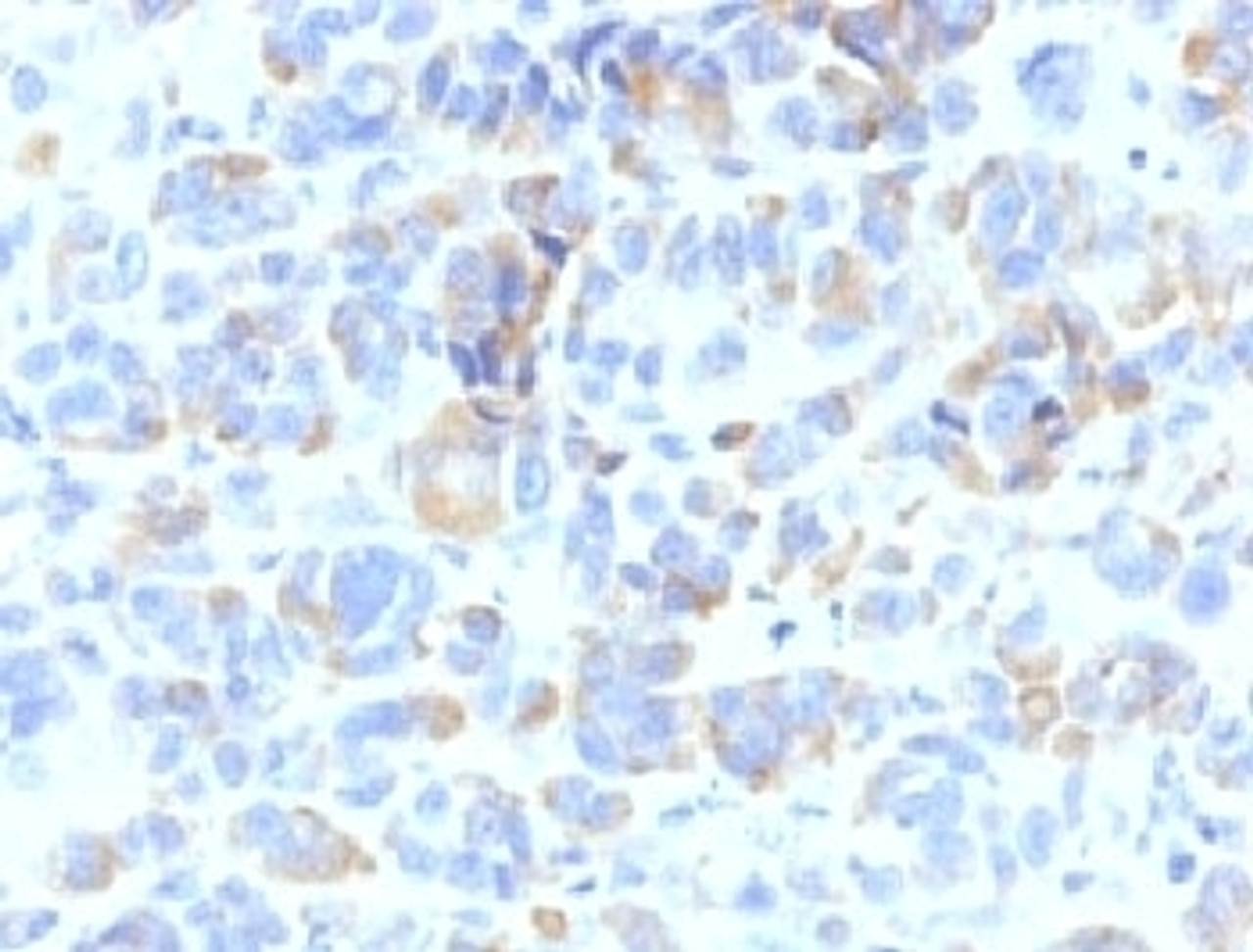Formalin-fixed, paraffin-embedded human melanoma stained with TYRP1 antibody (TYRP1/807)