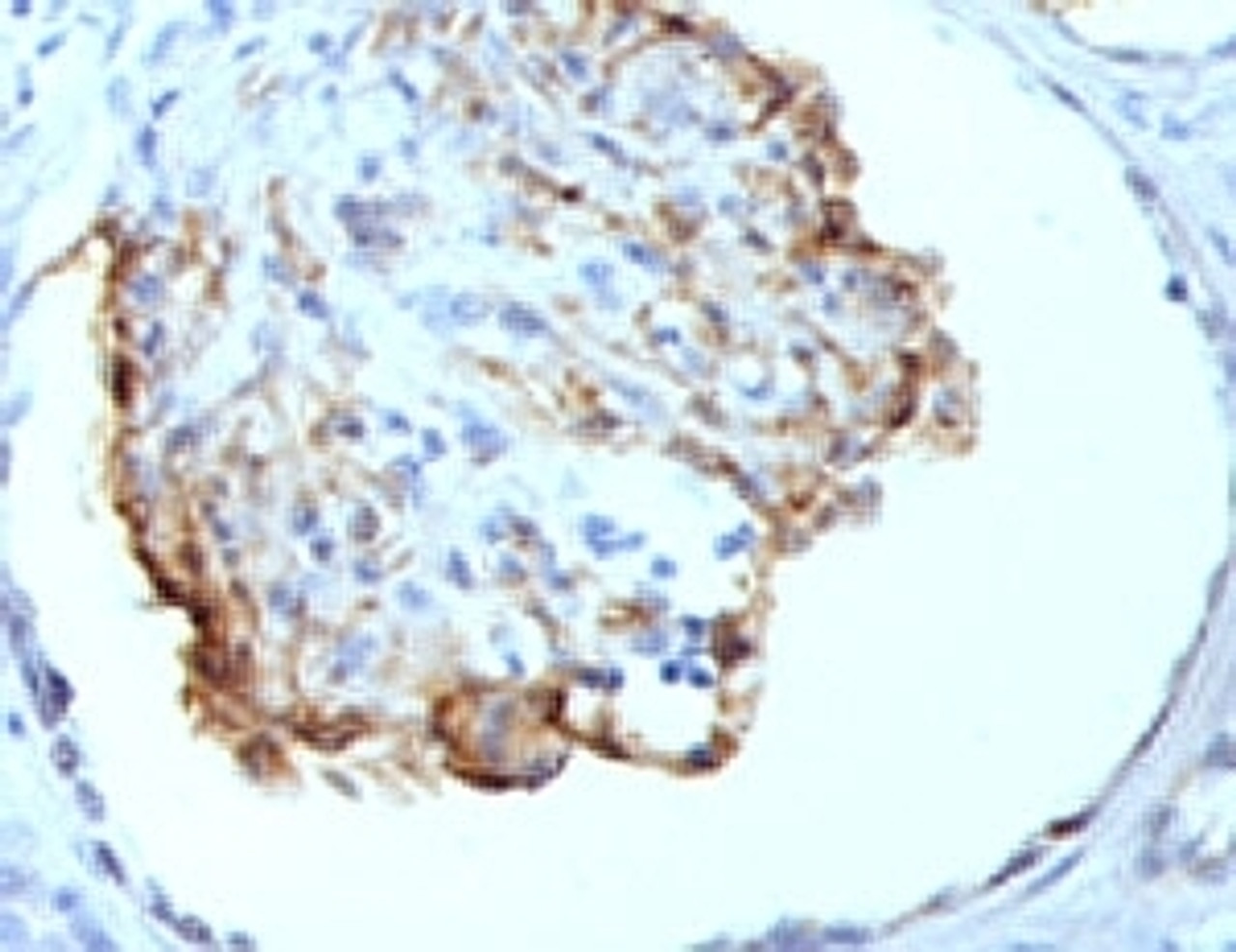 Formalin-fixed, paraffin-embedded human kidney stained with WT1 antibody (WT1/857) .