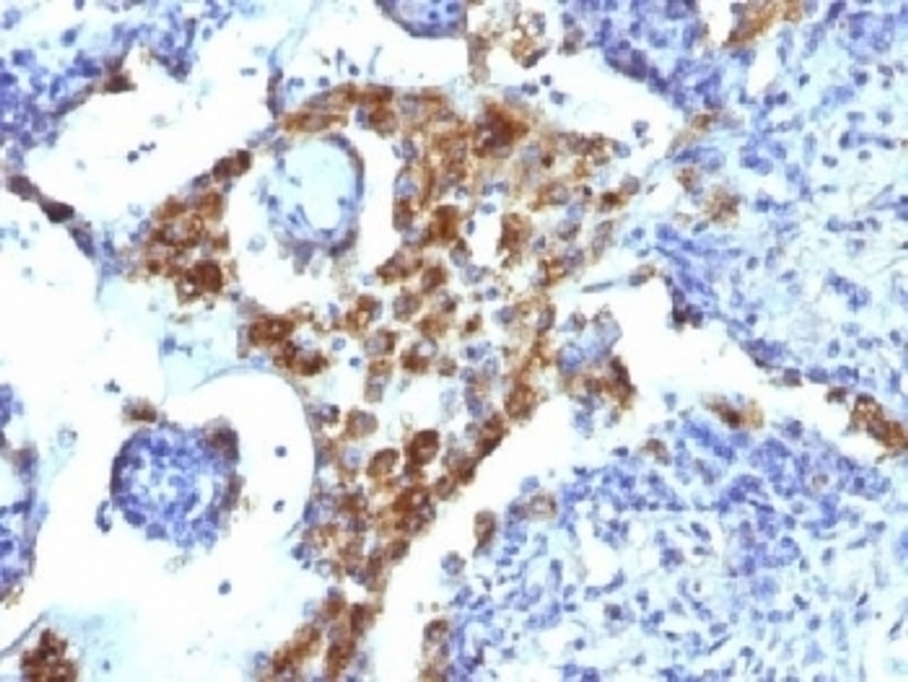 Formalin-fixed, paraffin-embedded human lung adenocarcinoma stained with Napsin-A antibody (NAPSA/1239) .