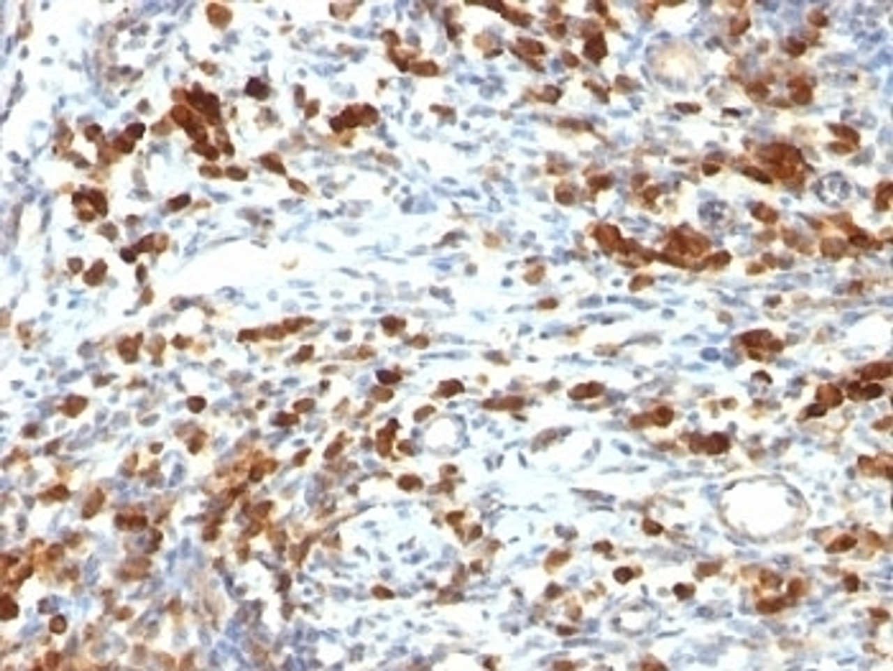 Formalin-fixed, paraffin-embedded human lymphoma stained with CD79a antibody (IGA/764) .