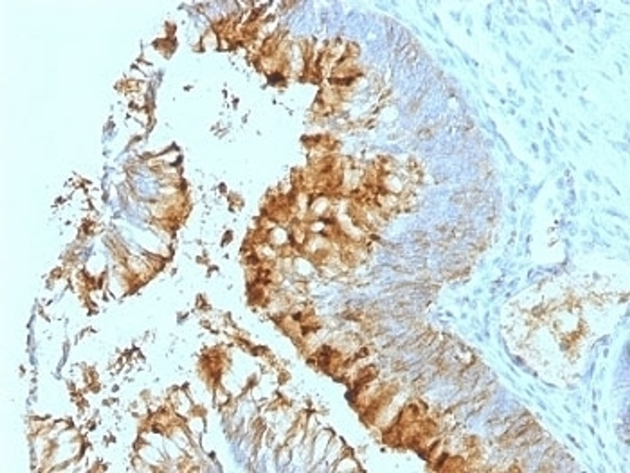 Formalin-fixed, paraffin-embedded human colon carcinoma stained with Blood Group Lewis a antibody (SPM279) .