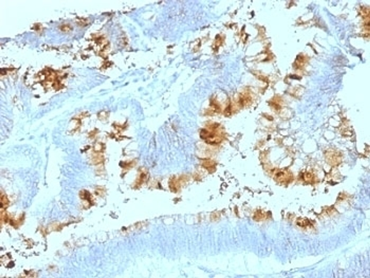 Formalin-fixed, paraffin-embedded human colon carcinoma stained with Blood Group Lewis a antibody (SPM522) .