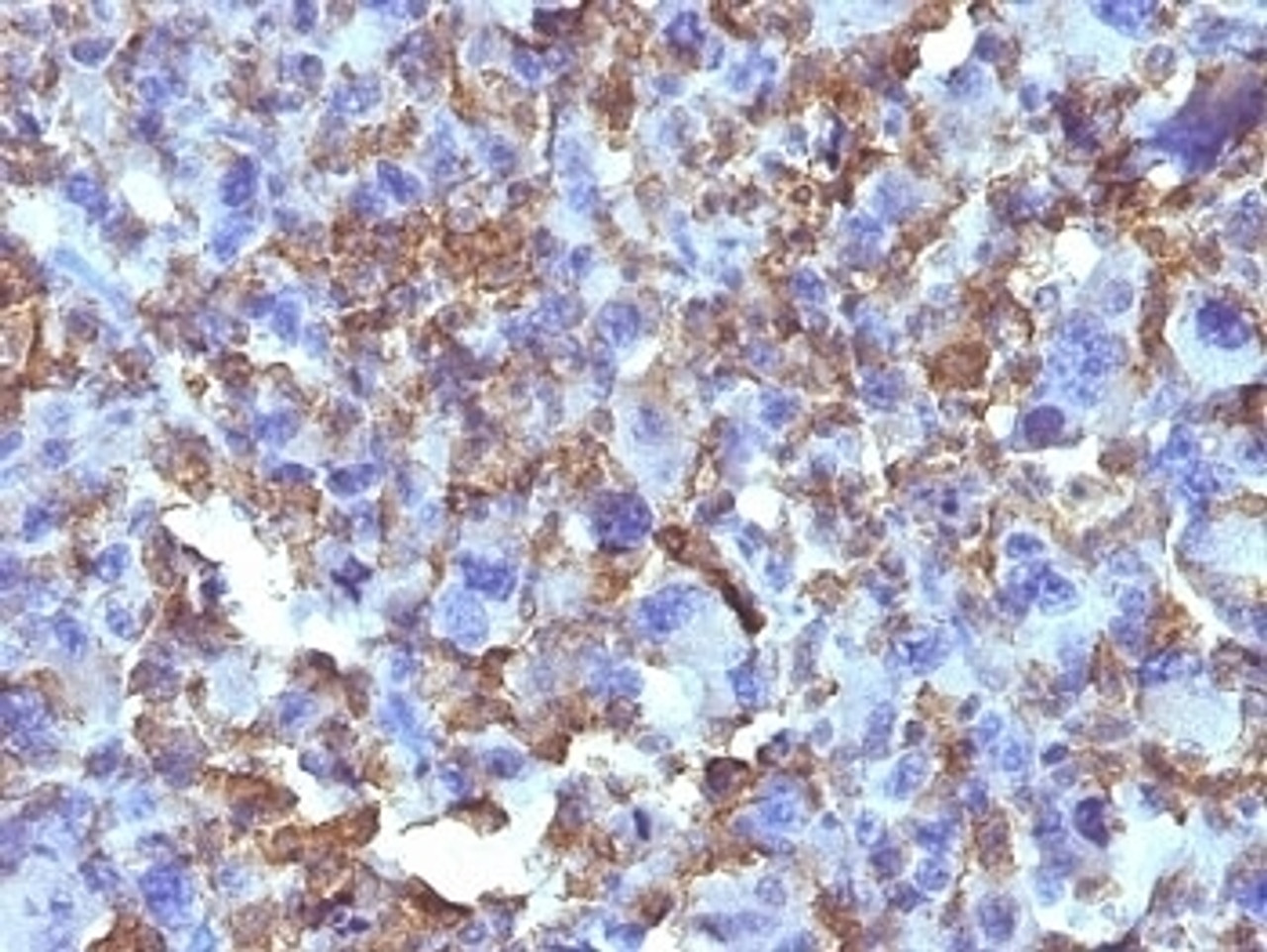 Formalin-fixed, paraffin-embedded human Histiocytoma stained with Macrophage antibody (D11) .