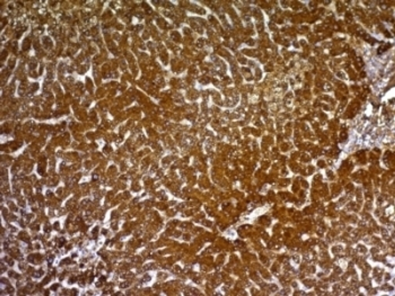 Formalin-fixed, paraffin-embedded human hepatocellular carcinoma stained with HepPar1 antibody.