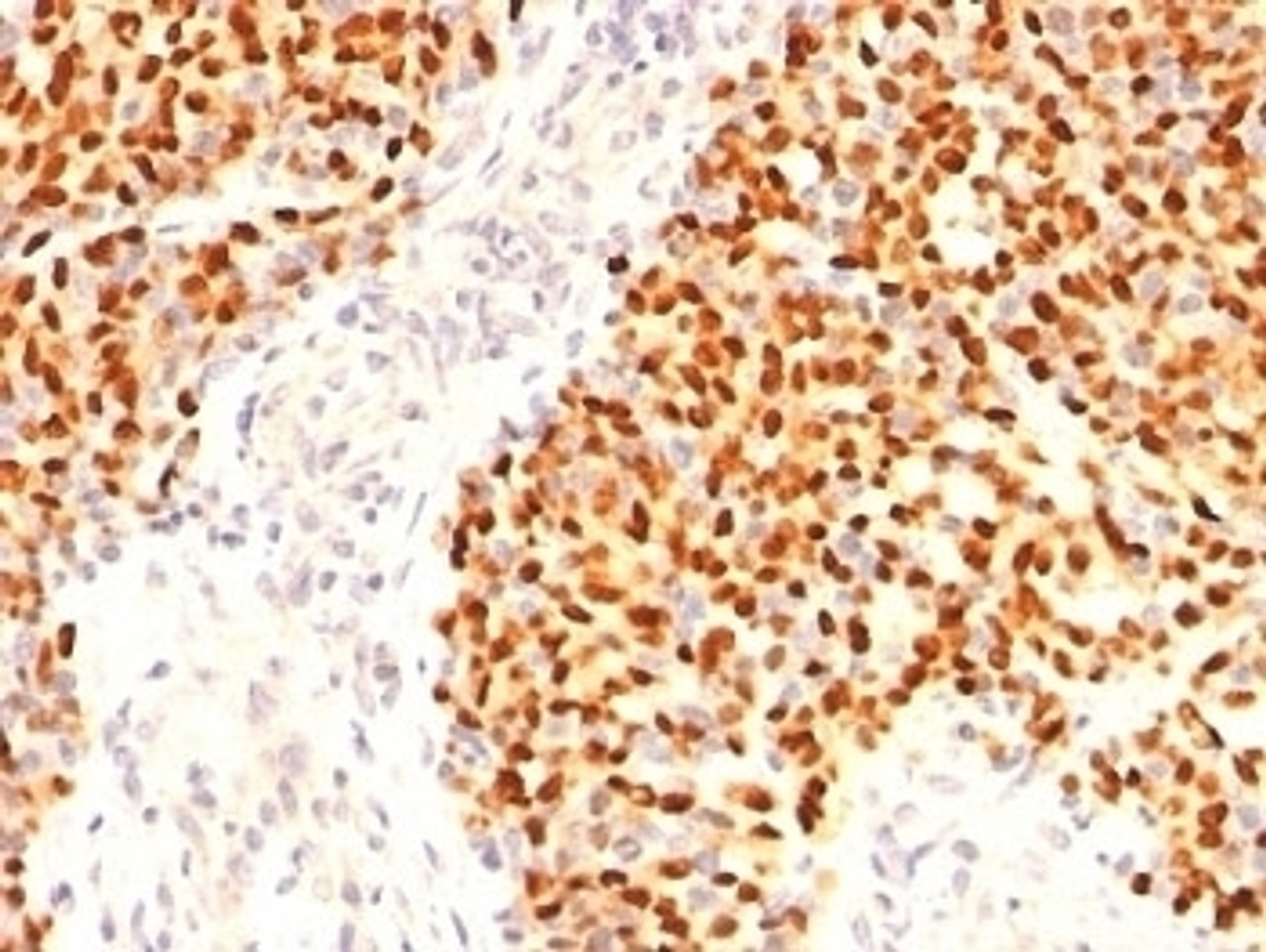 Formalin-fixed, paraffin-embedded human Rhabdomyosarcoma stained with Myogenin antibody (F5D)
