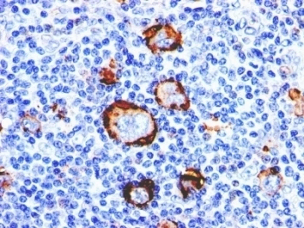 Formalin-fixed, paraffin-embedded human Hodgkin's lymphoma stained with CD15 antibody (Leu-M1) .