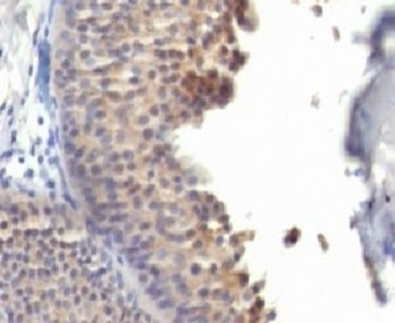 Formalin-fixed, paraffin-embedded human bladder carcinoma stained with anti-Keratin 10 antibody (KRT10/1275) .