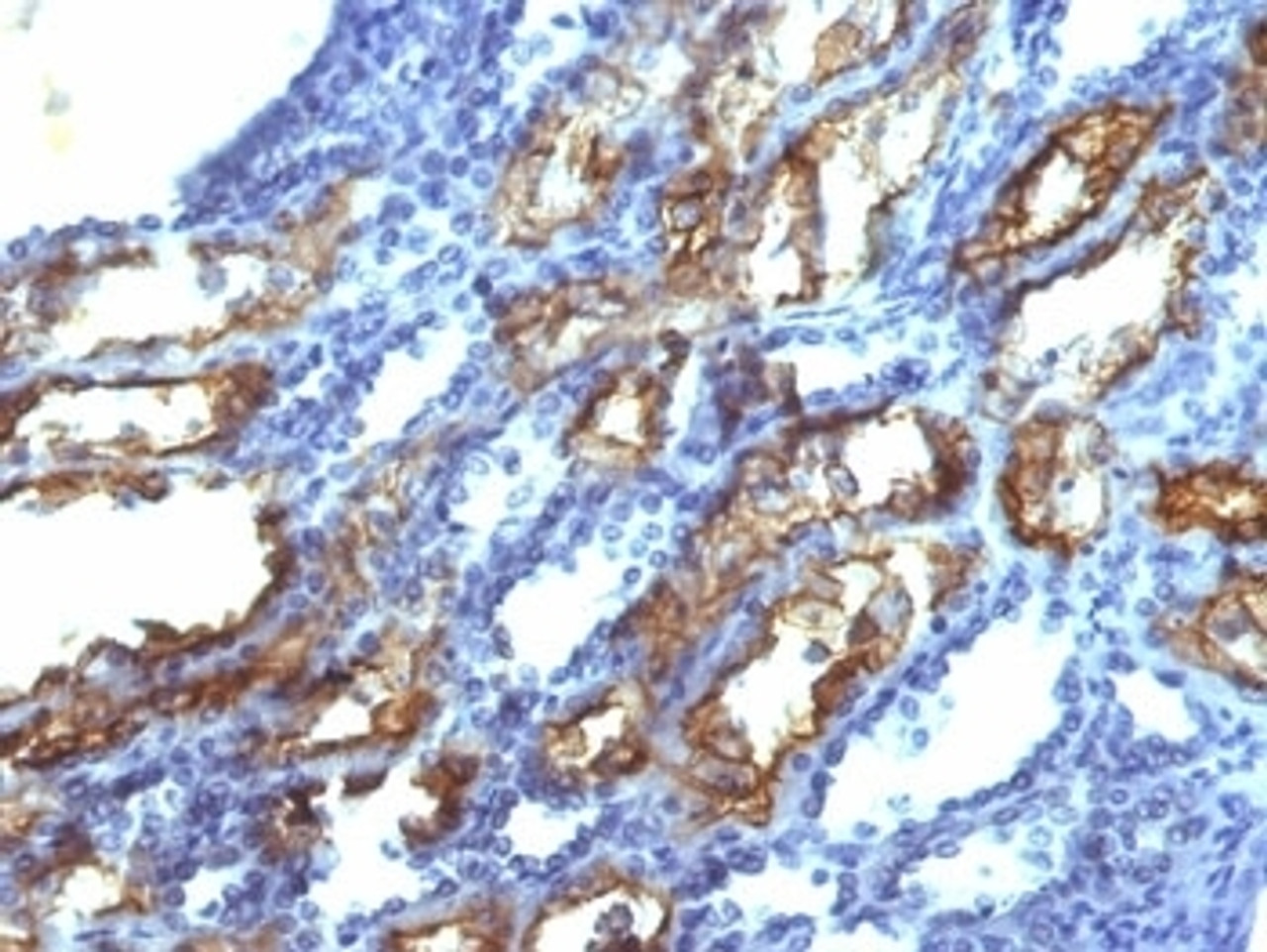 IHC testing of FFPE human renal cell carcinoma with IFN gamma antibody (clone IFNG/466) . Required HIER: boil tissue sections in 10mM Tris with 1mM EDTA, pH 9.0, for 10-20 min.