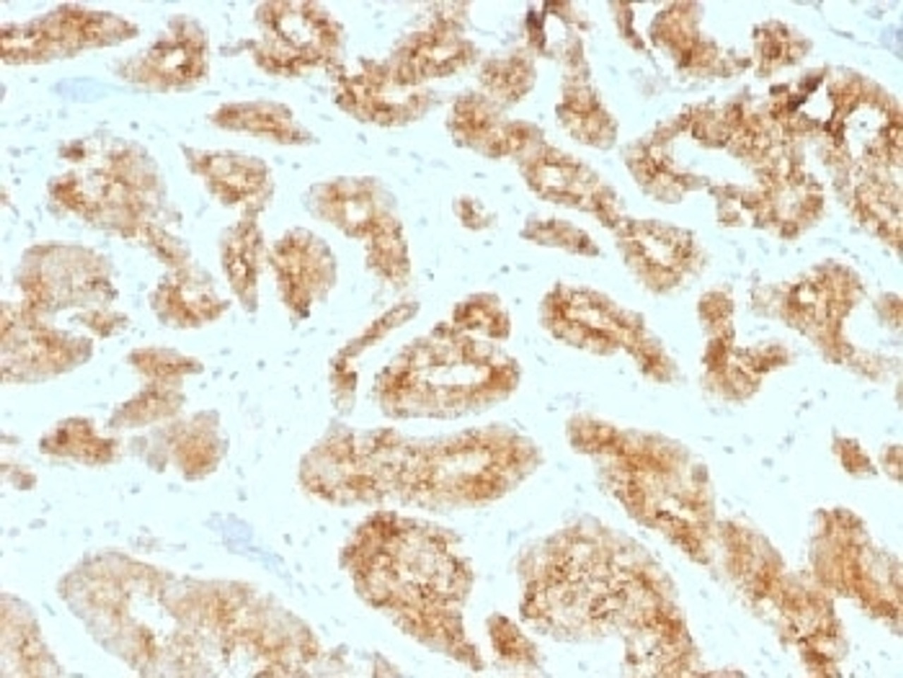 IHC testing of FFPE human prostate carcinoma with AMACR antibody (clone AMACR/1723) . HIER: steam sections in pH6, 10mM citrate buffer for 10-20 min.