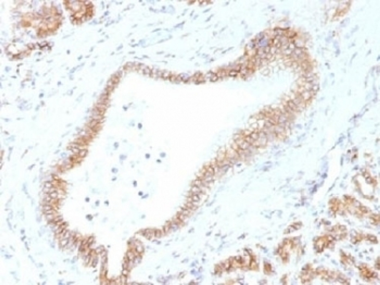 IHC testing of FFPE human pancreas tissue with Beta Catenin antibody (clone CTNNB1/1507) . Required HIER: boil tissue sections in 10mM Tris with 1mM EDTA, pH 9.0, for 10-20 min.