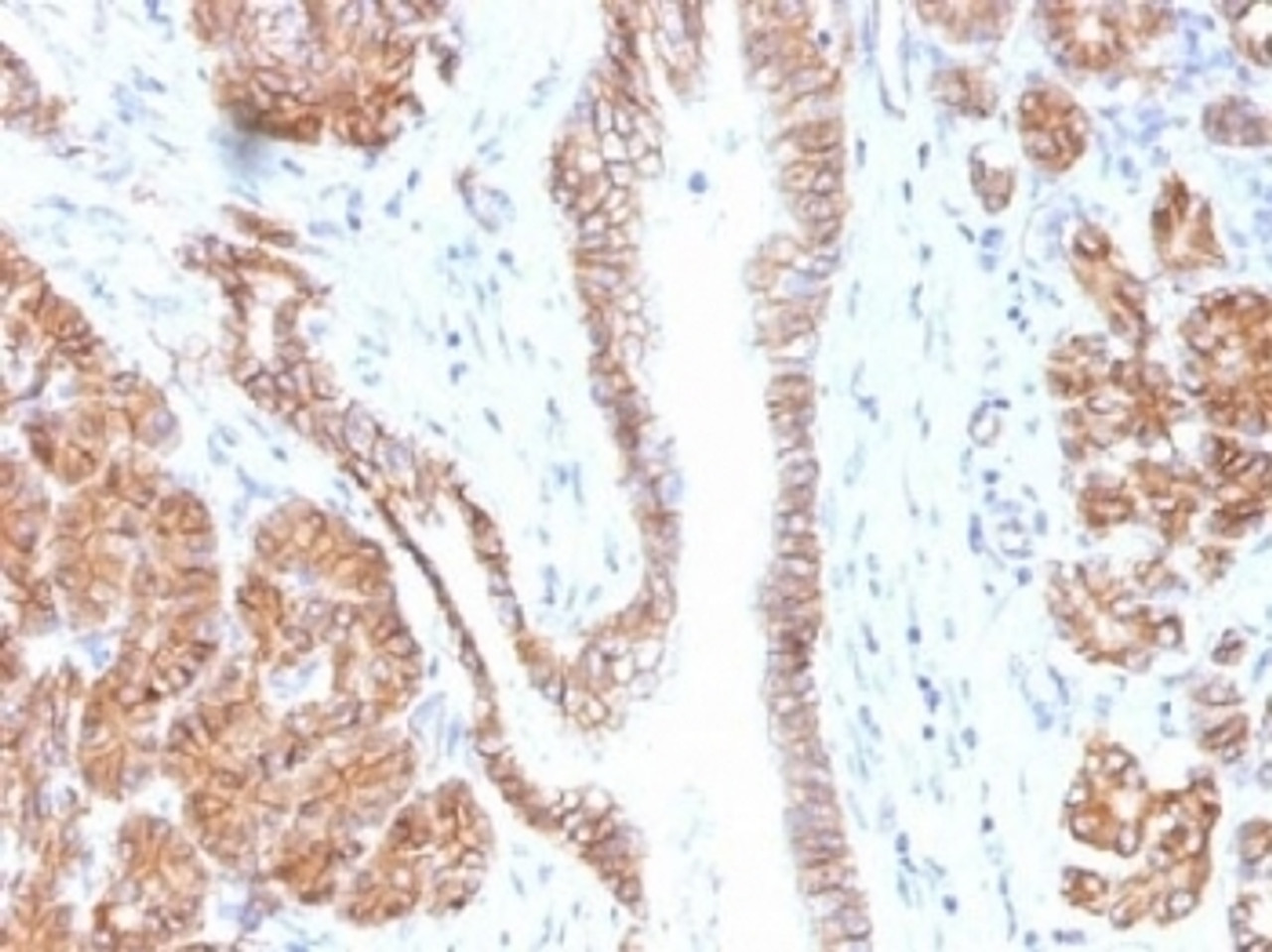 IHC testing of FFPE human pancreas tissue with Beta Catenin antibody (clone CTNNB1/1508) . Required HIER: boil tissue sections in 10mM Tris with 1mM EDTA, pH 9.0, for 10-20 min.