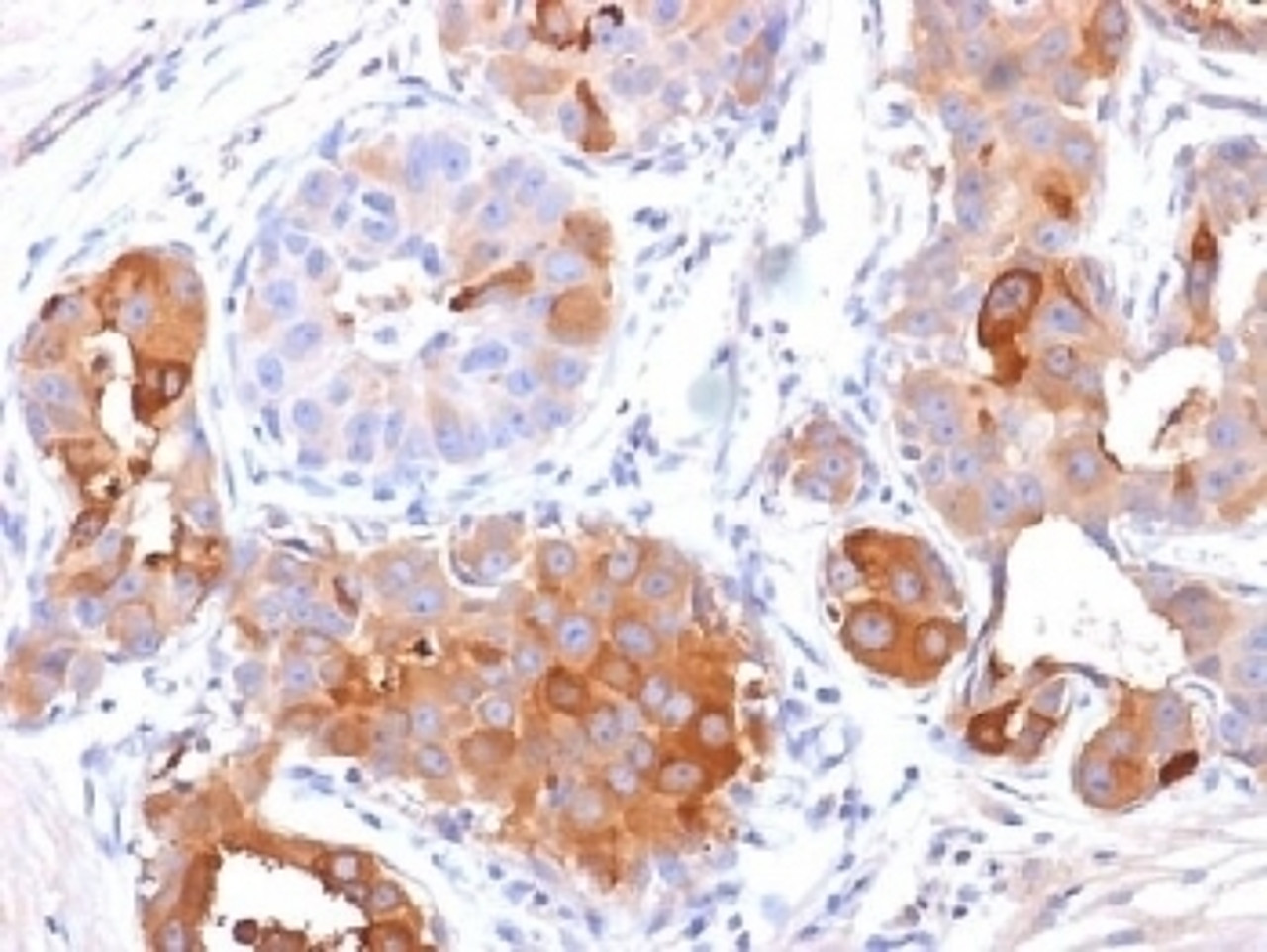 IHC testing of FFPE human breast carcinoma with PIP antibody (clone PIP/1571) . Required HIER: boil tissue sections in 10mM Tris with 1mM EDTA, pH 9, for 10-20.