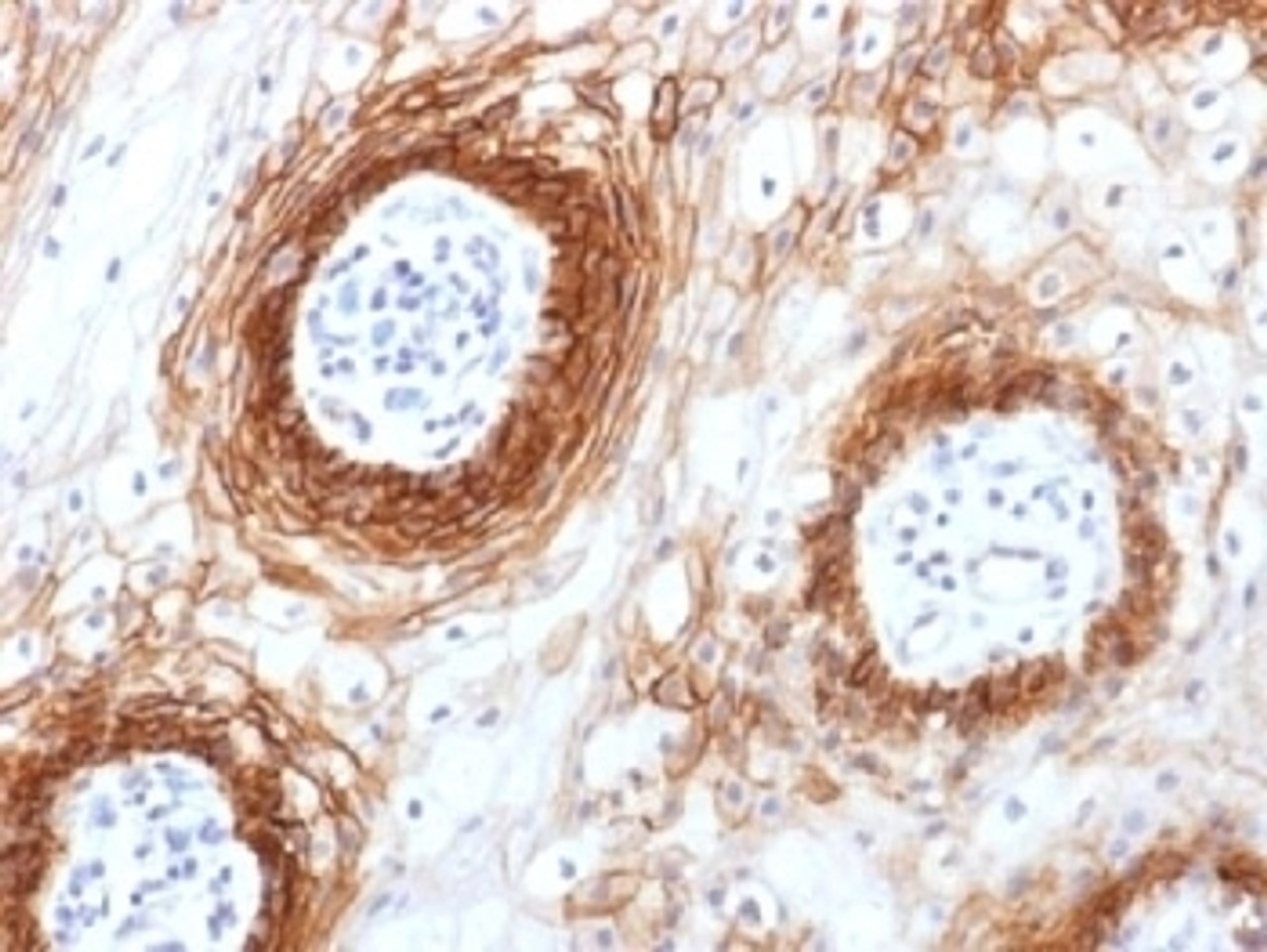 IHC testing of FFPE human tongue carcinoma with CD44v6 antibody (clone CD44v6/1246) . Required HIER: steam sections in pH6 citrate buffer for 10-20 min.