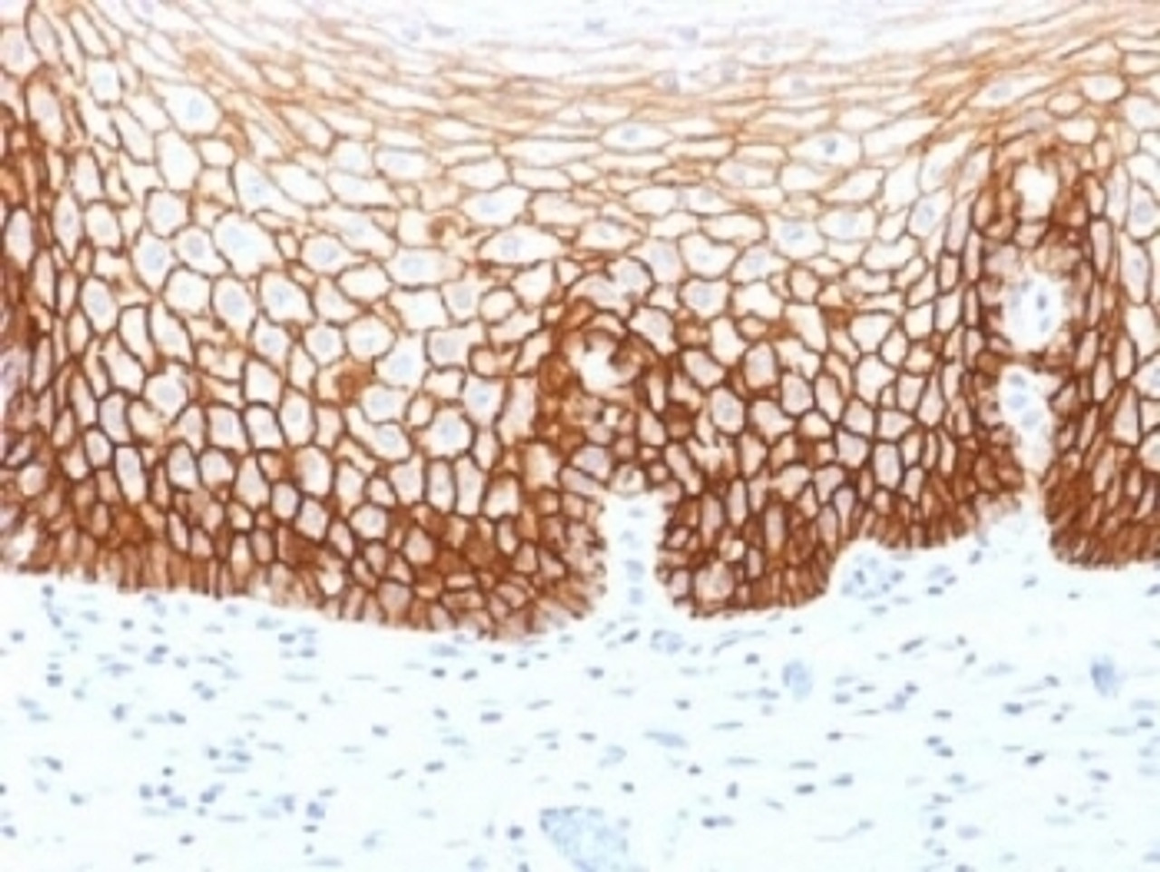 IHC testing of FFPE human cervical carcinoma with CD44v9 antibody (clone CD44v9/1459) . Required HIER: steam sections in pH6 citrate buffer for 10-20 min.