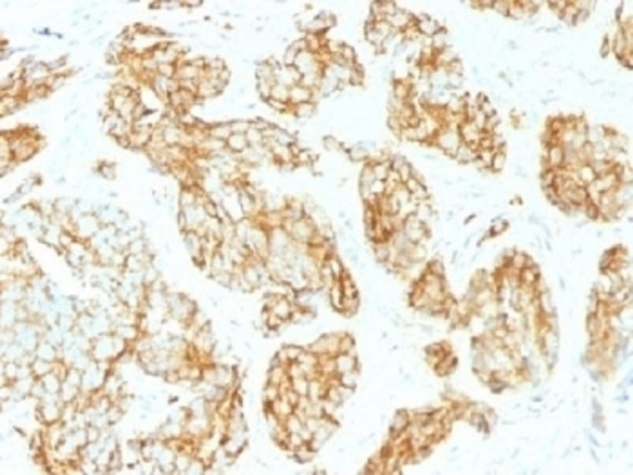 IHC testing of FFPE human prostate carcinoma with CD44v9 antibody (clone CD44v9/1459) . Required HIER: steam sections in pH6 citrate buffer for 10-20 min.