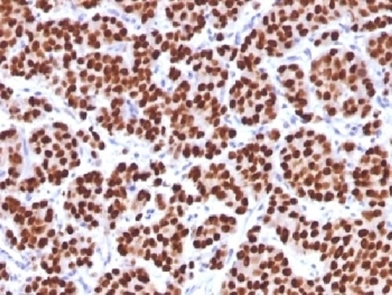 IHC testing of FFPE human prostate carcinoma with FOXA1 antibody (clone FOXA1/1512) . HIER: boil sections in 10mM Tris with 1mM EDTA, pH9, for 10-20 min.