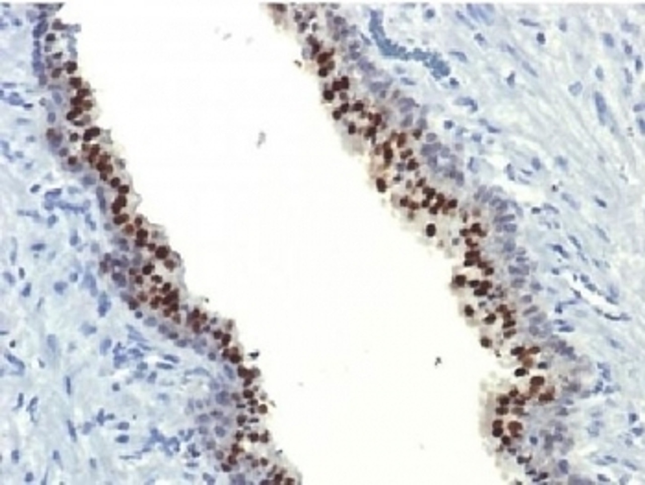 IHC testing of FFPE human prostate carcinoma with FOXA1 antibody (clone FOXA1/1514) . HIER: boil sections in 10mM Tris with 1mM EDTA, pH9, for 10-20 min.