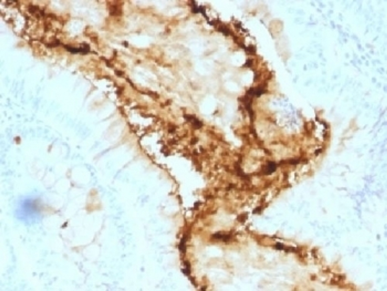 IHC testing of FFPE human colon carcinoma with Lewis y antibody (clone A70-A/A9) . Required HIER: boil tissue sections in 10mM citrate buffer, pH 6, for 10-20 min.