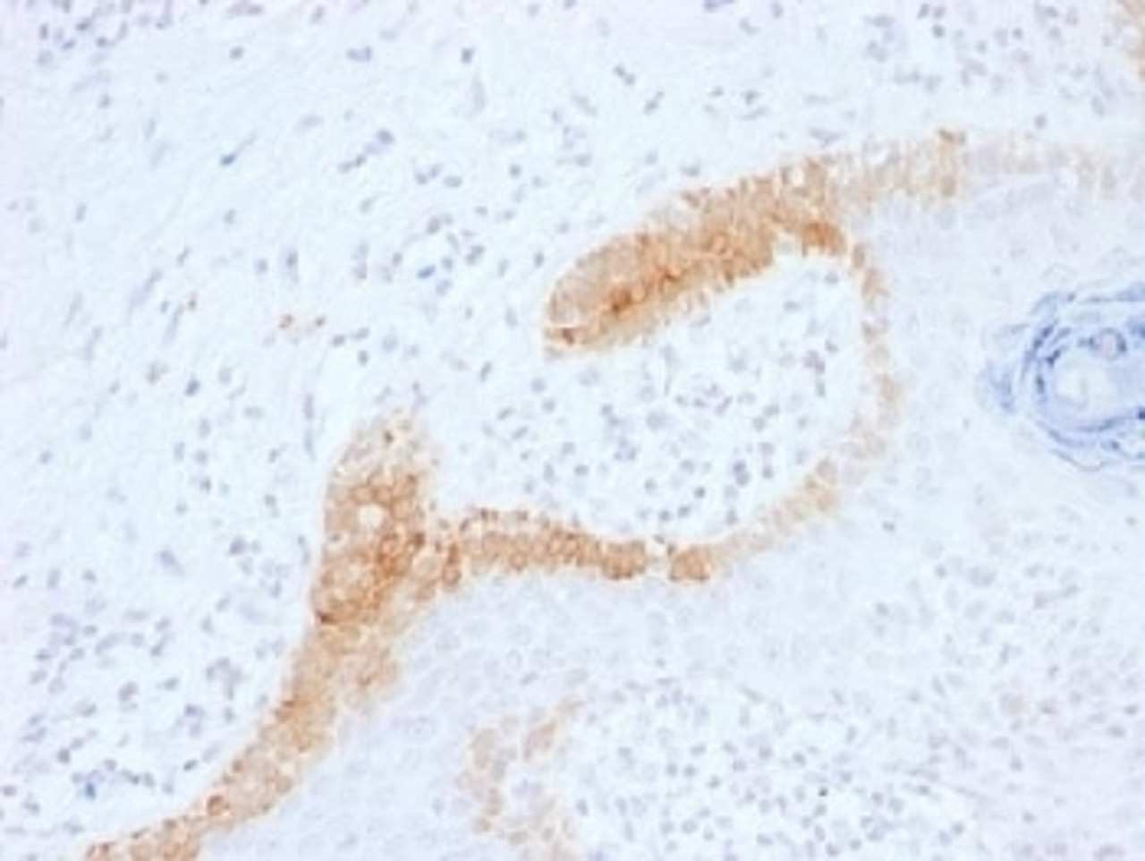 IHC testing of FFPE human basal cell carcinoma with Cytokeratin 10 antibody (clone KRT15/1699) . Required HIER: boil tissue sections in 10mM citrate buffer, pH 6, for 10-20 min.