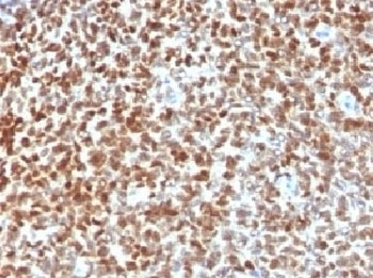 IHC testing of FFPE Ewings sarcoma with NKX2.2 antibody. HIER: steam sections in 10mM citrate buffer, pH 6.0, for 10-20 min.