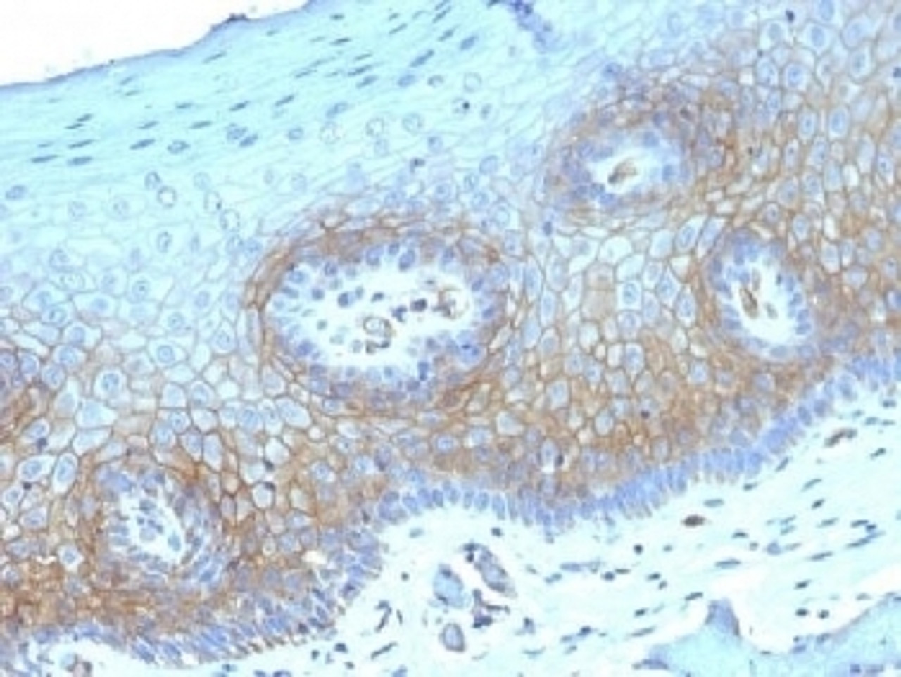 IHC testing of FFPE human cervical carcinoma with Thrombomodulin antibody (clone THBD/1782) . HIER: boil tissue sections in 10mM Tris buffer with 1mM EDTA, pH 9, for 10-20 min followed by cooling at RT for 20 min.