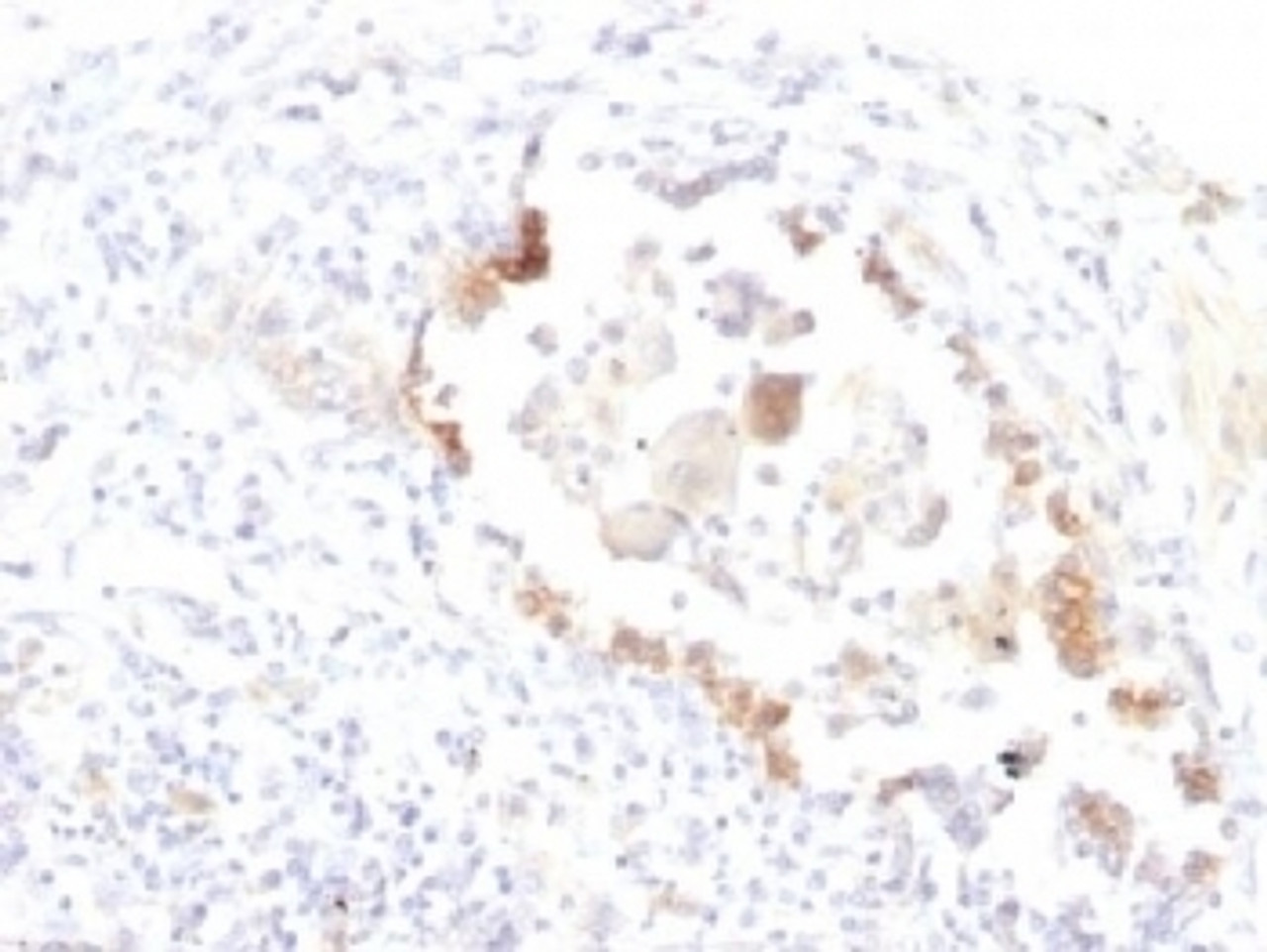 IHC testing of FFPE human lung carcinoma with Lewis y antibody (clone LWY/1463) . Required HIER: boil tissue sections in 10mM citrate buffer, pH 6, for 10-20 min.