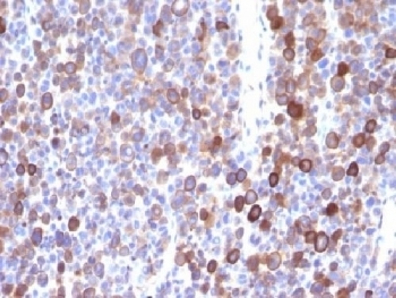 IHC testing of FFPE human melanoma with Moesin antibody (clone MSN/491) . Required HIER: boil tissue sections in 10mM citrate buffer, pH 6, for 10-20 min.